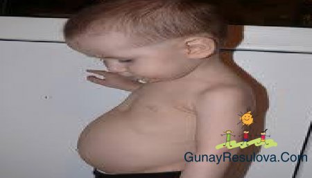 RAXİT XƏSTƏLİYİ HAQQİNDA