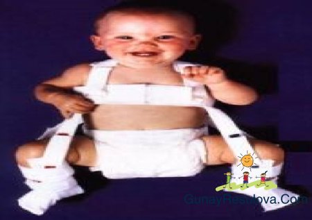 ANADANGƏLMƏ BUD-ÇANAQ OYNAĞI DİSPLAZİYASI