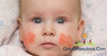 Atopik dermatit nədir?